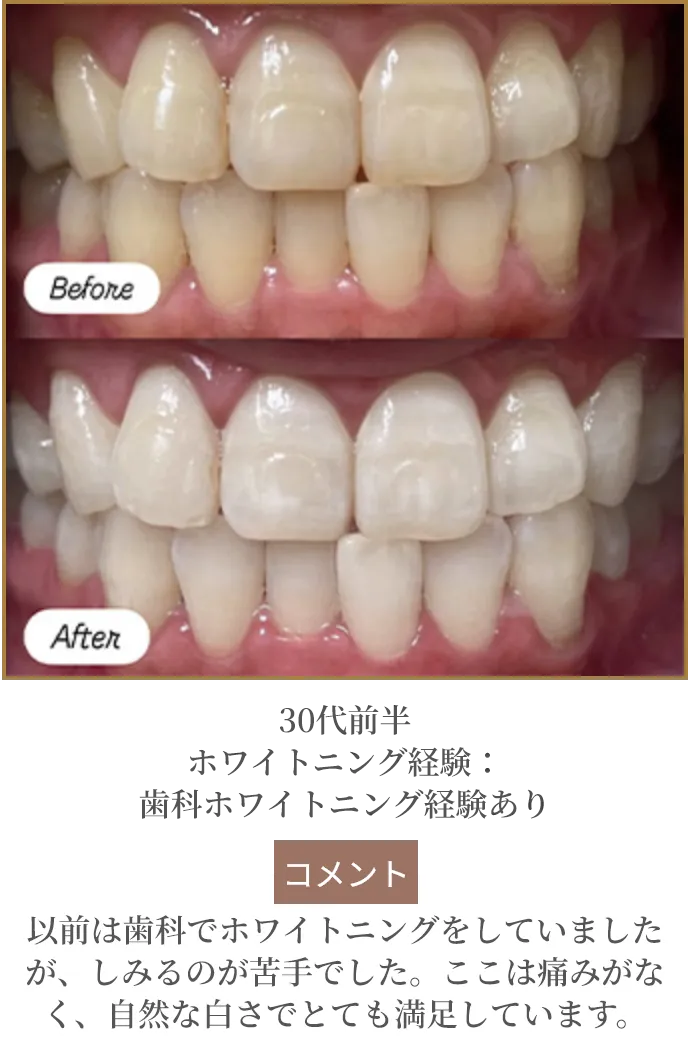 30代前半 ホワイトニング経験：歯科ホワイトニング経験あり