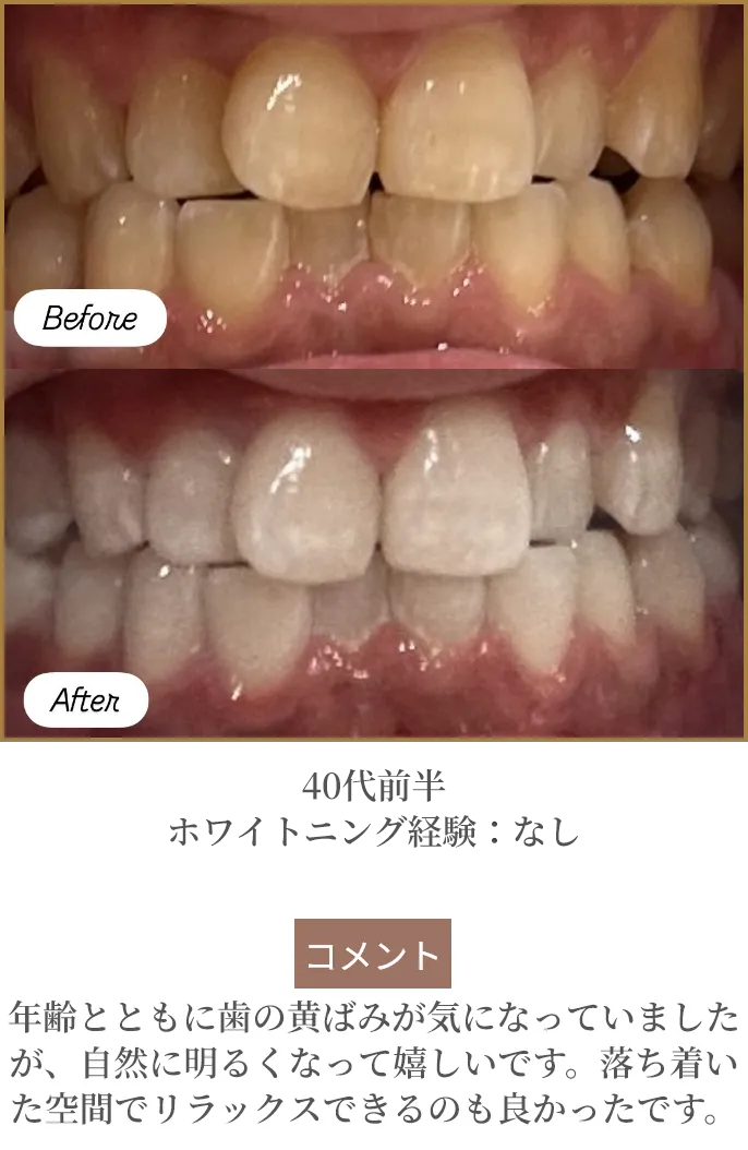 40代前半 ホワイトニング経験：なし