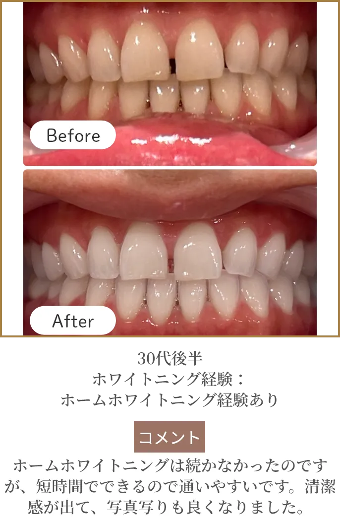 30代後半 ホワイトニング経験：ホームホワイトニング経験あり