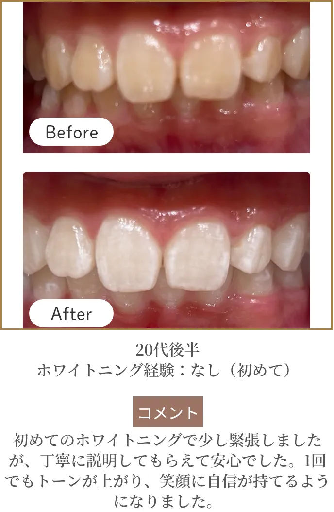 20代後半 ホワイトニング経験：なし（初めて）