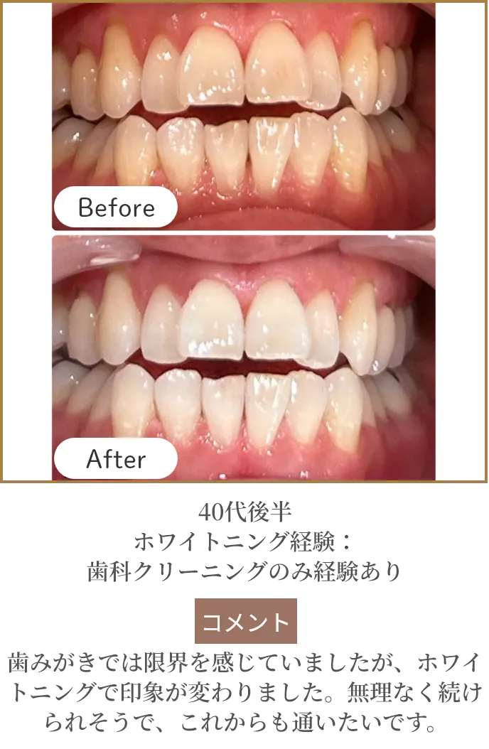 40代後半 ホワイトニング経験：歯科クリーニングのみ経験あり